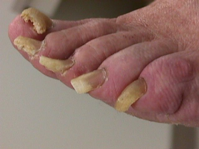 A person with yellow nails on their feet.